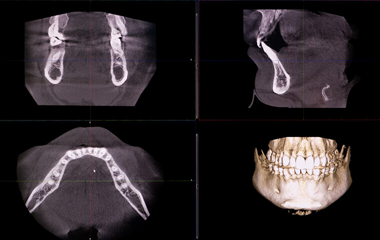 歯科用CTで立体的な分析