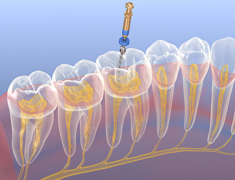 歯の根の治療は精密さが要求される繊細な治療です