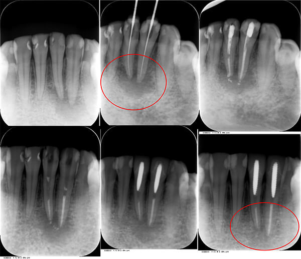 下顎前歯　他院にて抜歯症例　根管充填後治癒