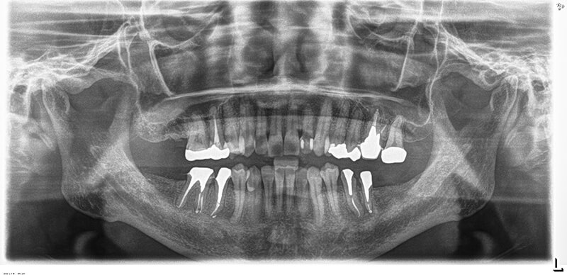 他院にて抜歯症例根管充填後治癒
