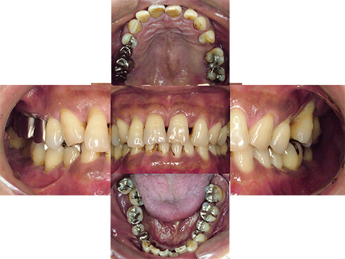 全顎的な重度の歯周病に対し臼歯部インプラント治療と上顎前歯に歯周再生療法を施し10年が経過した症例