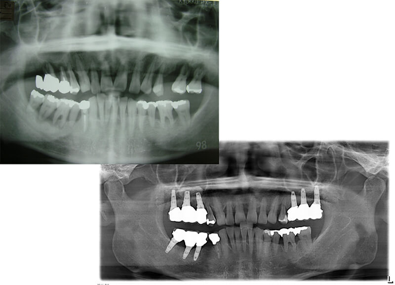 全顎的な重度の歯周病に対し臼歯部インプラント治療と上顎前歯に歯周再生療法を施し10年が経過した症例