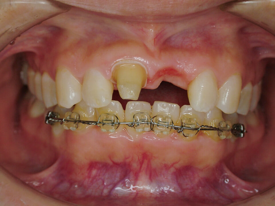 上顎前歯の歯根破折・抜歯ケースにインプラント審美治療を行った症例