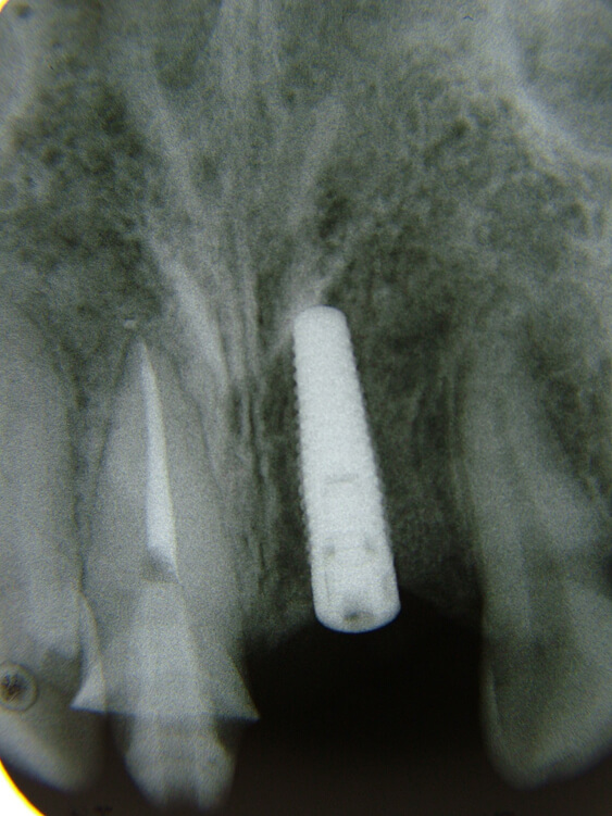 上顎前歯の歯根破折・抜歯ケースにインプラント審美治療を行った症例