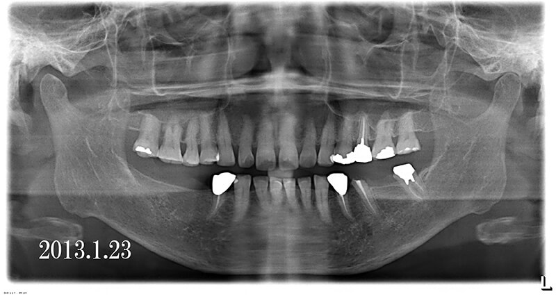 臼歯の欠損にインプラント補綴処置を行った症例