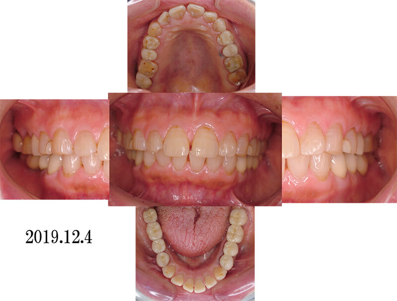 臼歯の欠損にインプラント補綴処置を行った症例