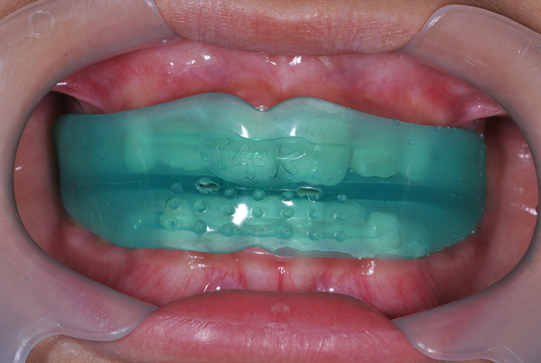 歯列矯正用咬合誘導装置（T4Kトレーナーシステム）