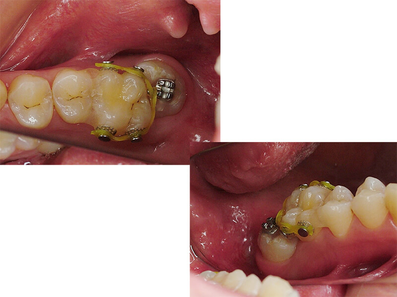 上顎第2大臼歯保存不可、親知らずを矯正治療にて治療