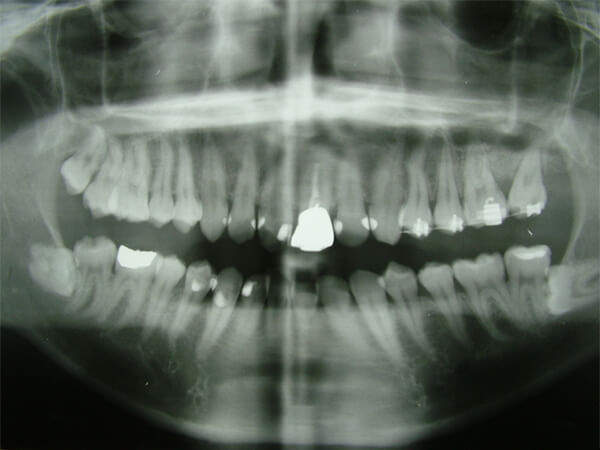 上顎第2大臼歯保存不可、親知らずを矯正治療にて治療