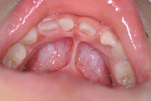 上唇小帯・舌小帯のレーザー切除治療について