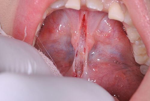 上唇小帯・舌小帯のレーザー切除治療について