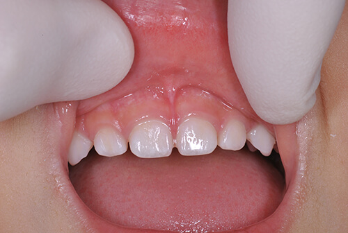 上唇小帯・舌小帯のレーザー切除治療について