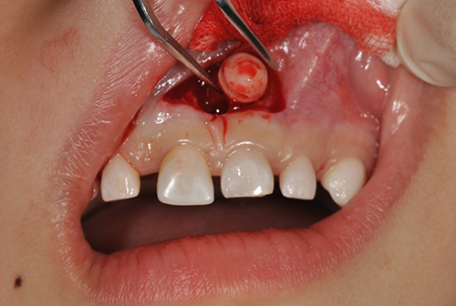 過剰歯抜歯の例