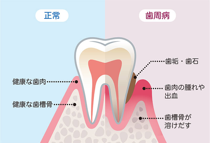 成人の約8割が歯周病予備軍です