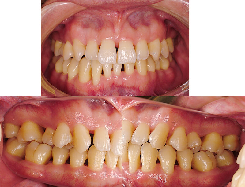 全顎的な歯周病にエムドゲインを用いた再生治療をおこなった症例