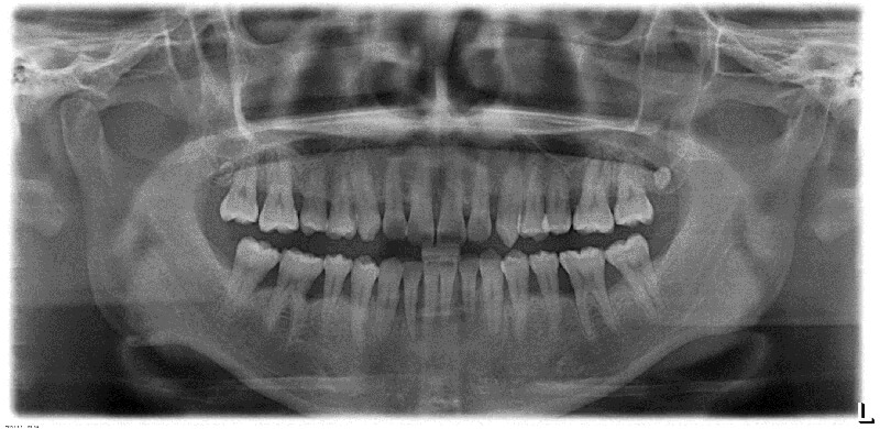 全顎的な歯周病にエムドゲインを用いた再生治療をおこなった症例