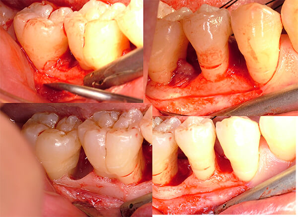 全顎的な歯周病にエムドゲインを用いた再生治療をおこなった症例