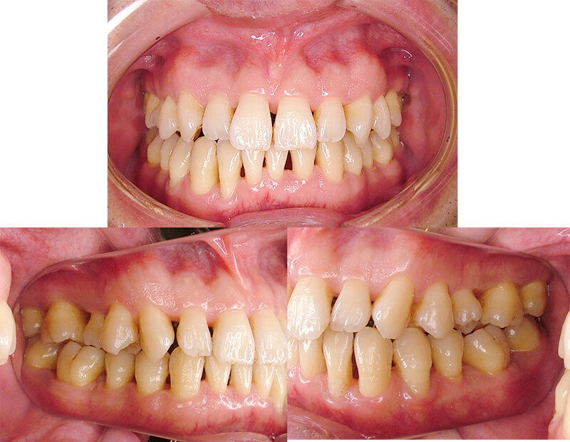 全顎的な歯周病にエムドゲインを用いた再生治療をおこなった症例