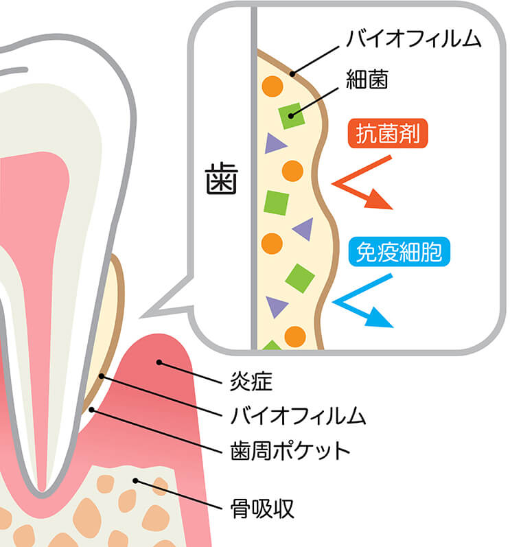 虫歯の原因菌の“すみか”は3ヶ月でつくられます